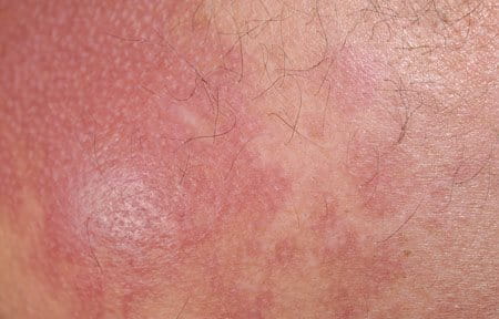 Sunburn is characterised by red, sore and blistering skin.