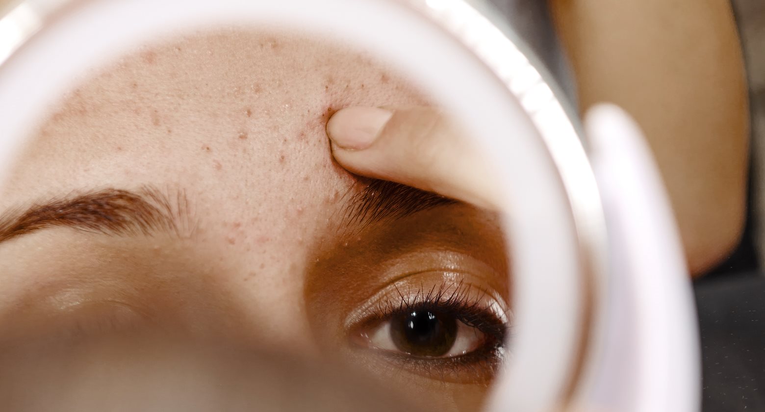 The Different Types Of Acne Acne Eucerin