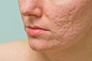 Treating and removing acne scars