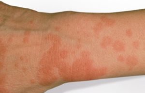Close-up of skin with a photoallergic reaction