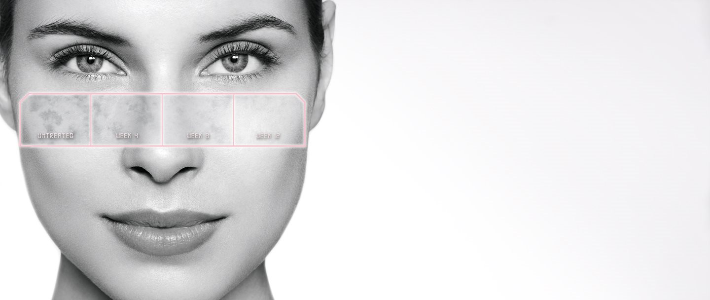 Development of hyperpigmenation on female skin