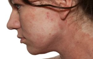 Woman's profile with red skin in cheak area.