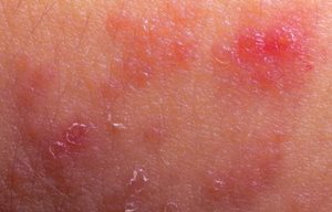 Flaky infected looking skin.