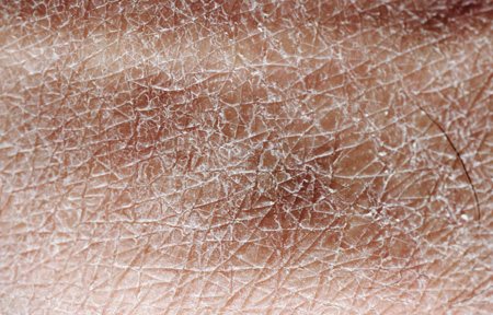 Close-up of very dry skin