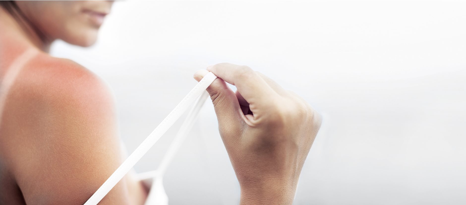 Woman with superficial sun-burn